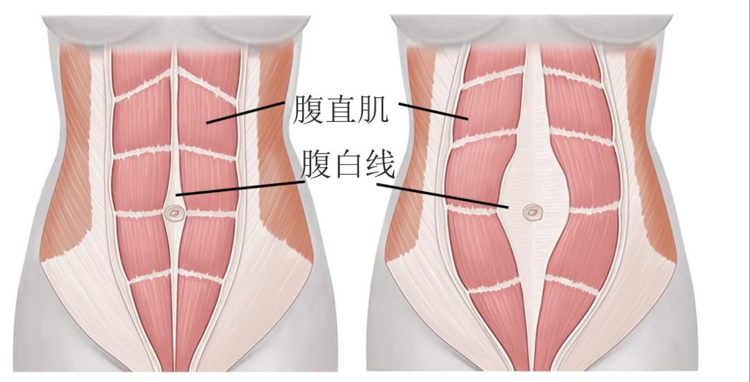 腹白线图片怀孕图片