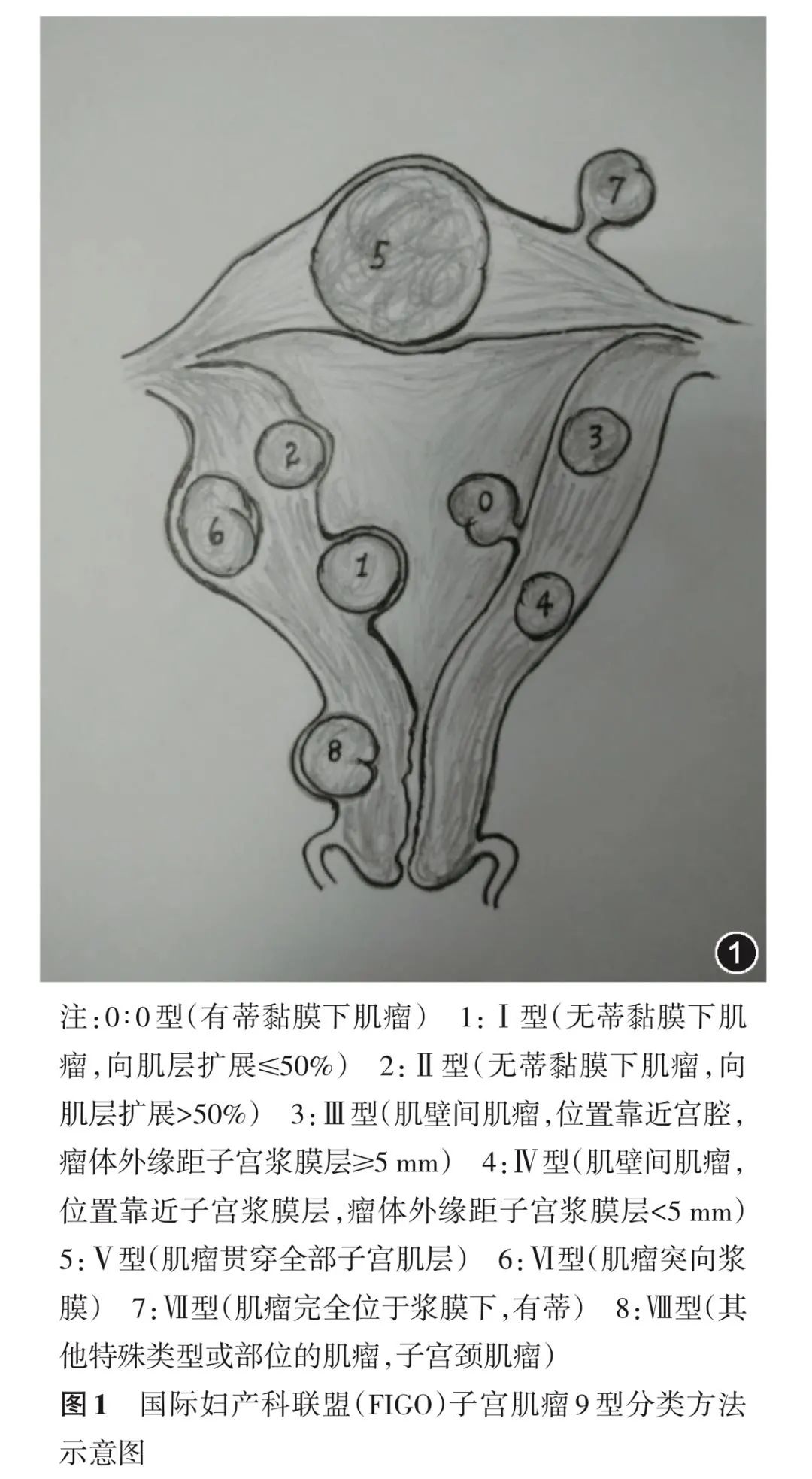 肌瘤钻怎么写「没注意阴道分泌物的这个状况，我差点失去了子宫……」_https://www.jmylbn.com_新闻资讯_第3张