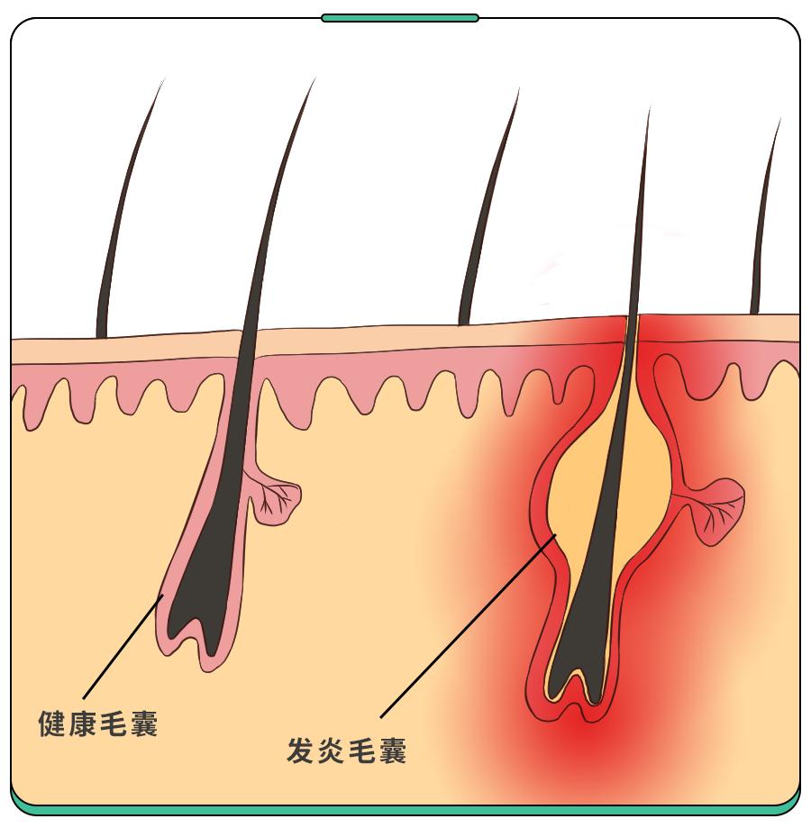 痤疮or毛囊炎?孩子身上这种痘到底是啥?