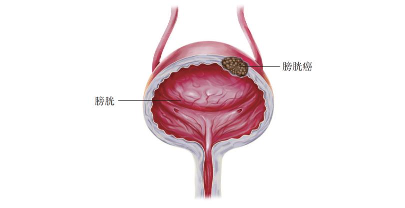 为什么男性更容易患膀胱癌?