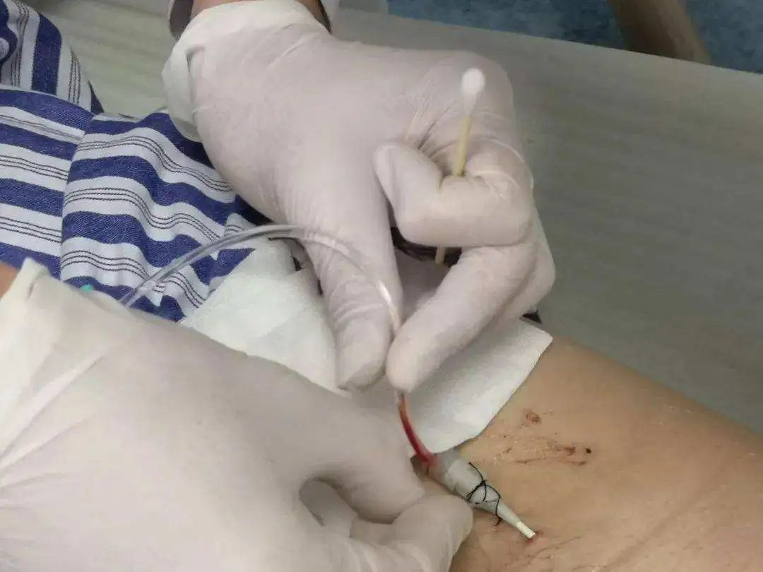 3第三针是中心静脉穿刺置管,一般有颈内静脉,锁骨下静脉,股静脉供选择