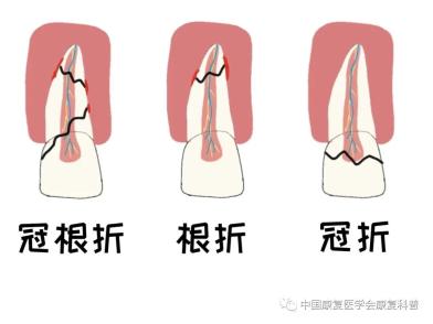 牙齿外伤的防治管理