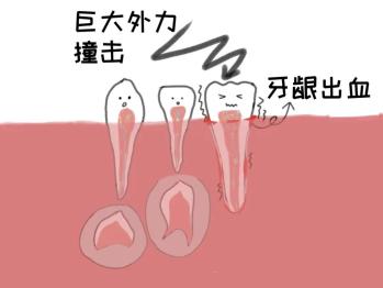 【口腔健康系列科普】牙齿外伤的防治管理