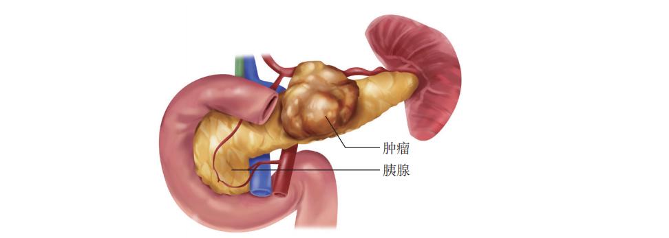 为什么胰腺癌被称为“癌中之王”?_澎湃号·湃客_澎湃新闻-The Paper