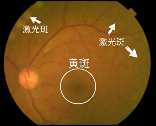 【病案现场】只要黄斑功能好,术后视力就有惊喜