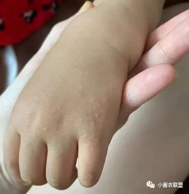 "沙土皮炎"是玩沙子引起的吗?_澎湃号·湃客_澎湃新闻-the paper