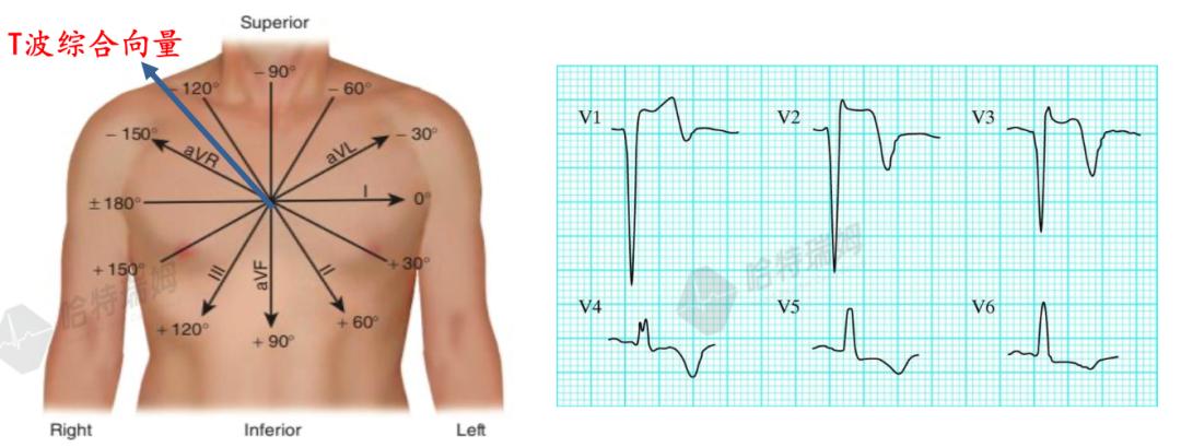 心电图示下侧壁导联q波形成,下壁导联和v3~v6导联中st段抬高伴t波倒置