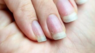 指甲长白点不是缺钙，真要担心的指甲是这样的……