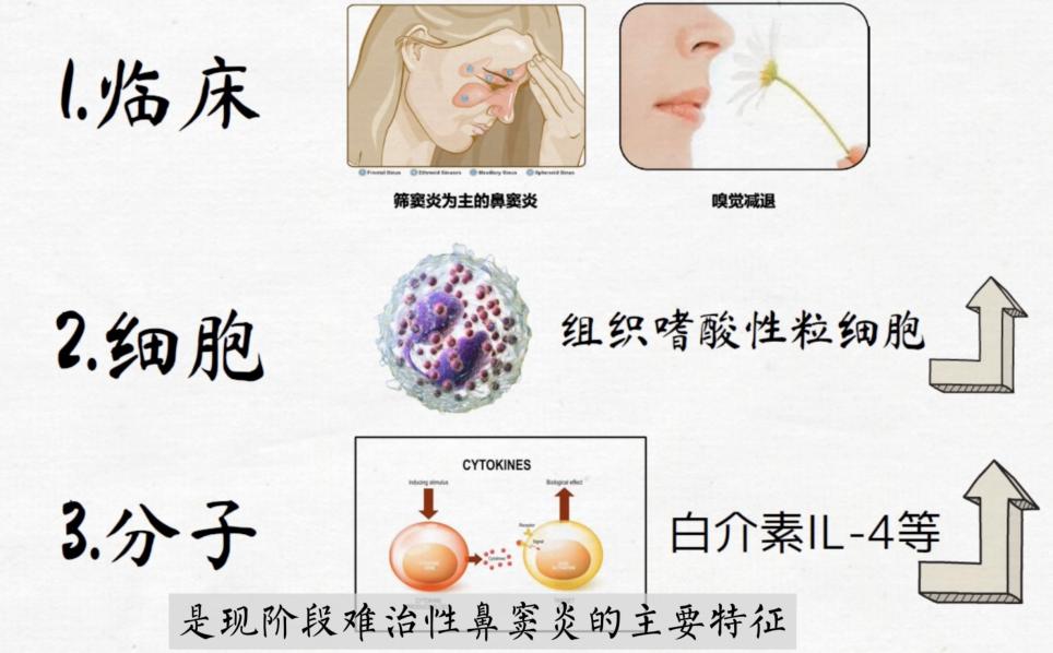 仁济科普 | 还在饱受难治性鼻窦炎的困扰？这些治疗方法了解一下