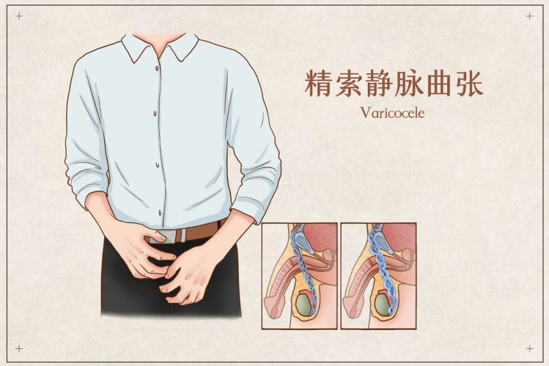 困扰不少男性的精索静脉曲张,竟然是不育的最常见因素?