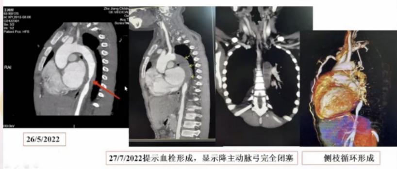 什么是加用治疗大动脉炎的诊断与治疗，看这篇就够了_https://www.jmylbn.com_新闻资讯_第1张