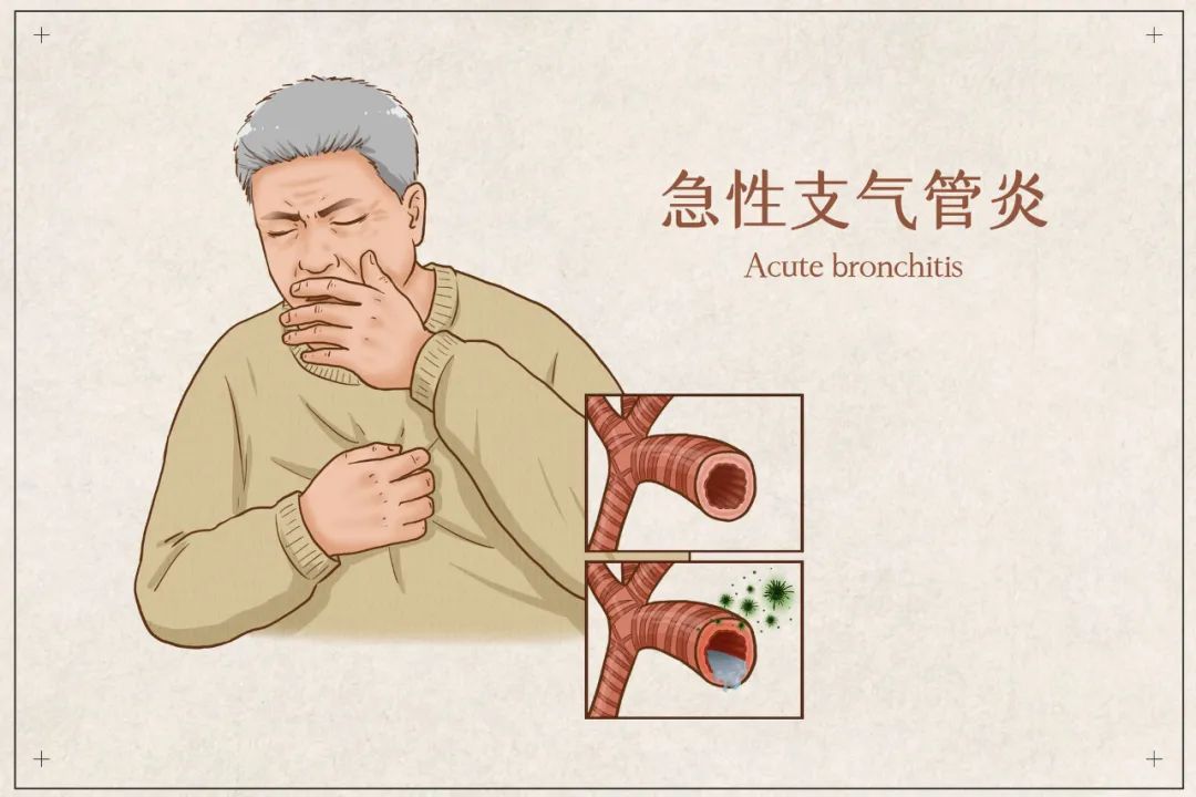 急性气管-支气管炎怎么治？