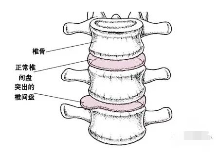 腰椎间盘突出到底能治好吗?