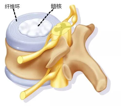 颈椎纤维环图片