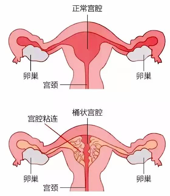 宫腔粘连是指各种原因导致的子宫内膜基底层损伤