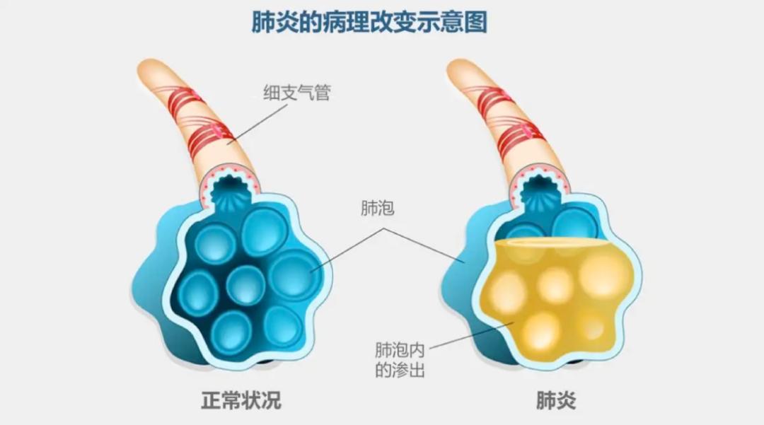 肺炎是指终末气道