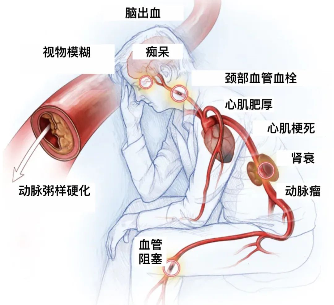 高血压指南惹争议,130/80以上应该这样吃