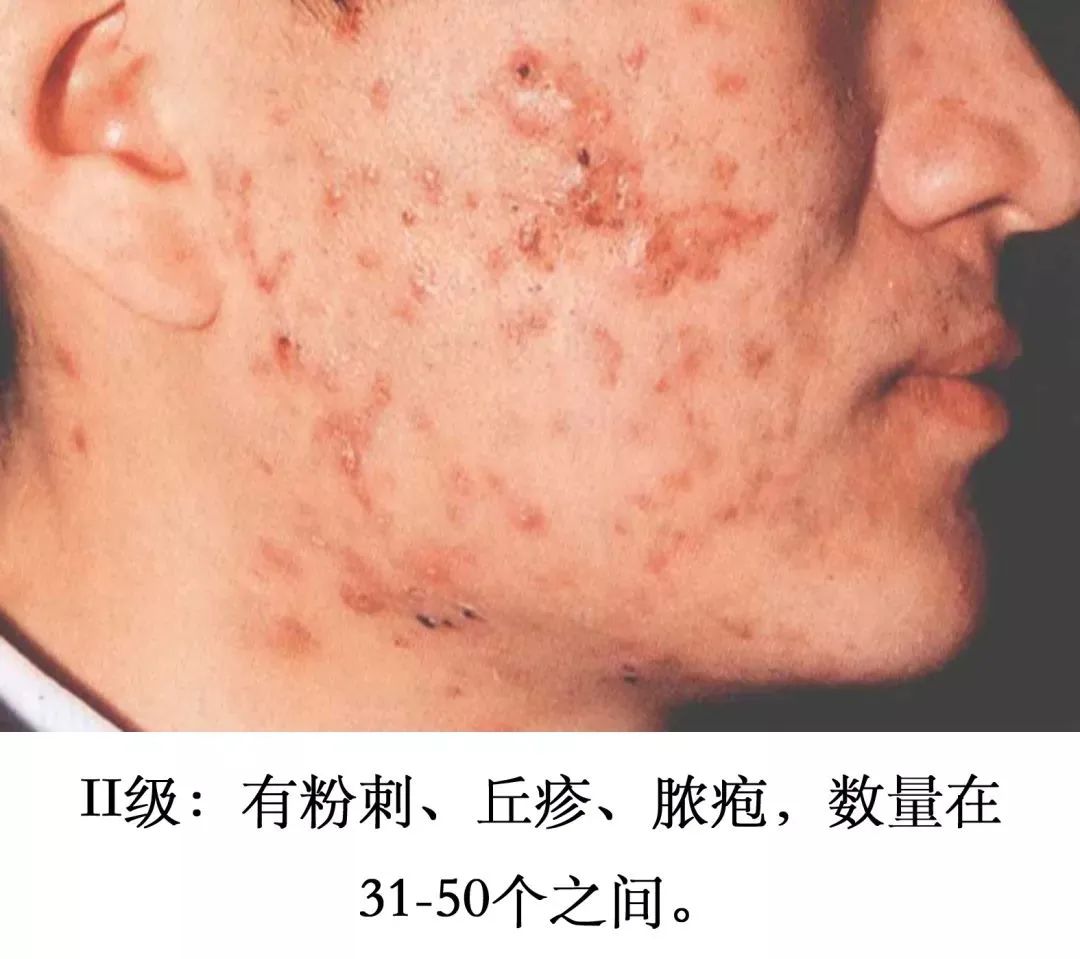 如何养成一张干净的脸?现在知道还不晚_澎湃号·湃客_澎湃新闻-The Paper