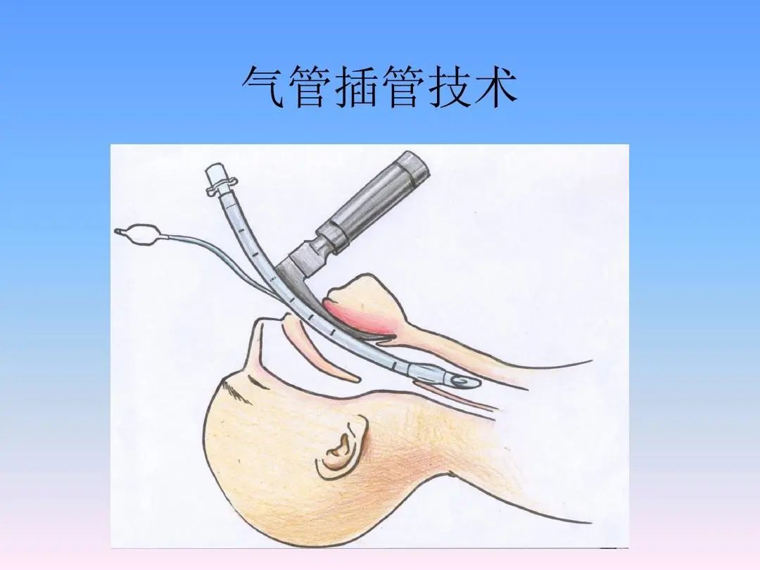 管创伤可引起严重出血,除非患者急救,否则以上情况下禁忌气管内插管。