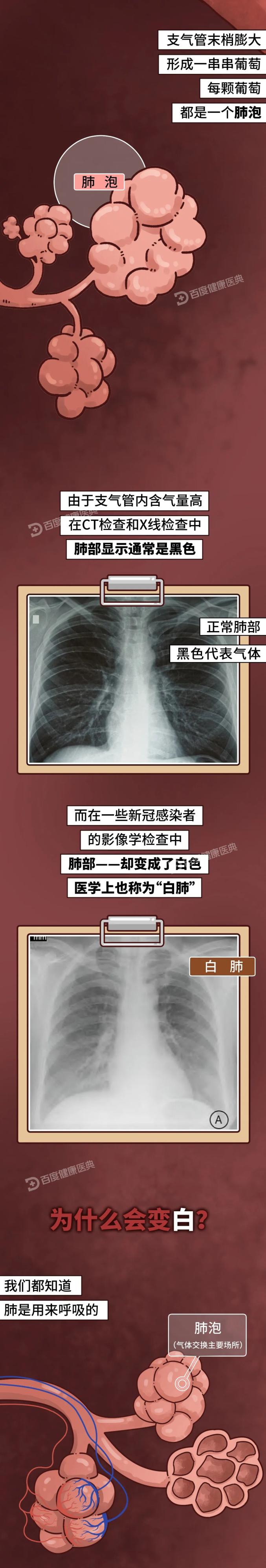 一图看懂新冠是怎么伤害肺的?_澎湃号·政务_澎湃新闻-the paper