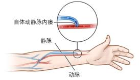 动脉留置针怎么输液世界肾脏日｜血液透析患者的血管通路——终生使用的“生命线”_https://www.jmylbn.com_新闻资讯_第8张