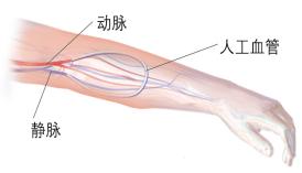 动脉留置针怎么输液世界肾脏日｜血液透析患者的血管通路——终生使用的“生命线”_https://www.jmylbn.com_新闻资讯_第9张