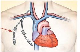 动脉留置针怎么输液世界肾脏日｜血液透析患者的血管通路——终生使用的“生命线”_https://www.jmylbn.com_新闻资讯_第10张