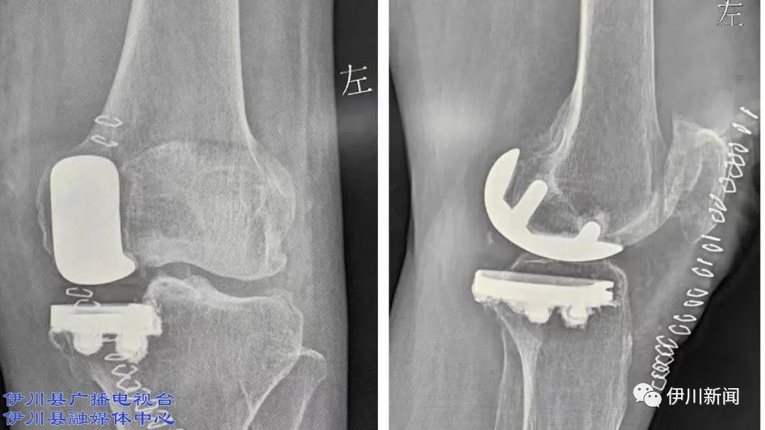 伊川总医院:微创单髁置换!