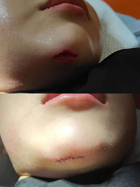 手术缝合针线怎么消毒急，宝宝的脸摔出好大口子，哪里能缝美容针？_https://www.jmylbn.com_新闻资讯_第3张