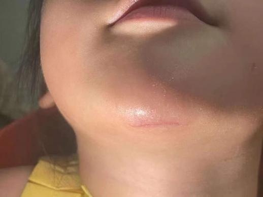 手术缝合针线怎么消毒急，宝宝的脸摔出好大口子，哪里能缝美容针？_https://www.jmylbn.com_新闻资讯_第4张