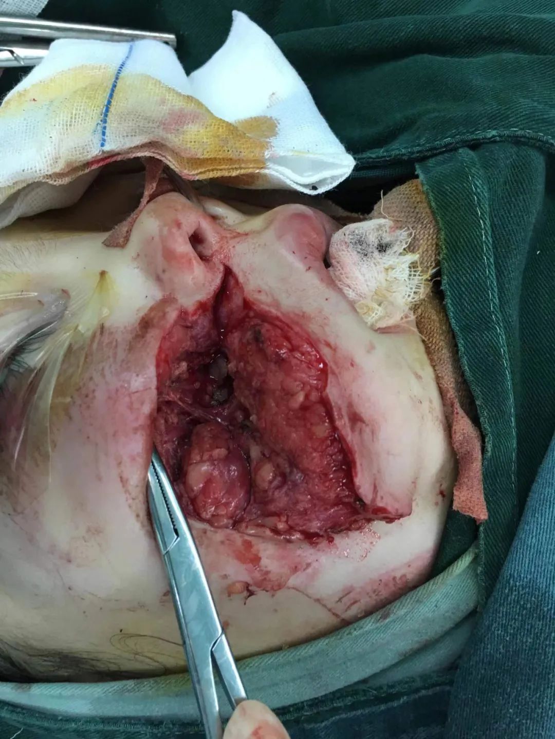 手术缝合针线怎么消毒急，宝宝的脸摔出好大口子，哪里能缝美容针？_https://www.jmylbn.com_新闻资讯_第5张