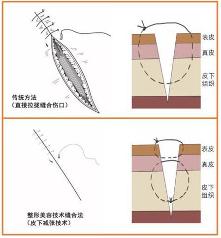 手术缝合针线怎么消毒急，宝宝的脸摔出好大口子，哪里能缝美容针？_https://www.jmylbn.com_新闻资讯_第8张