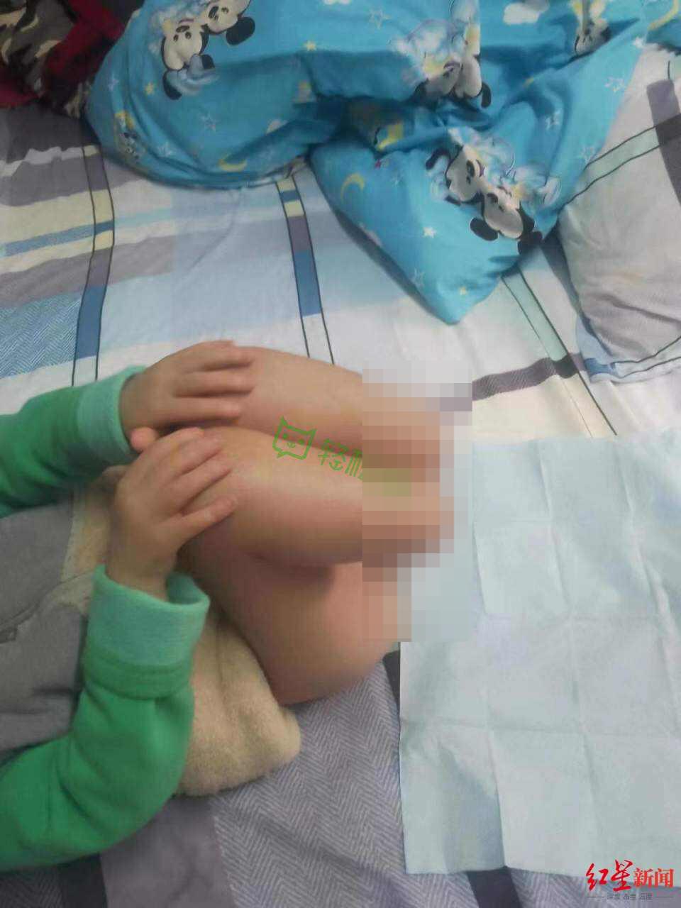 xbdf 5岁男童被生母虐待双腿截肢，父亲：之前只觉她脾气急躁