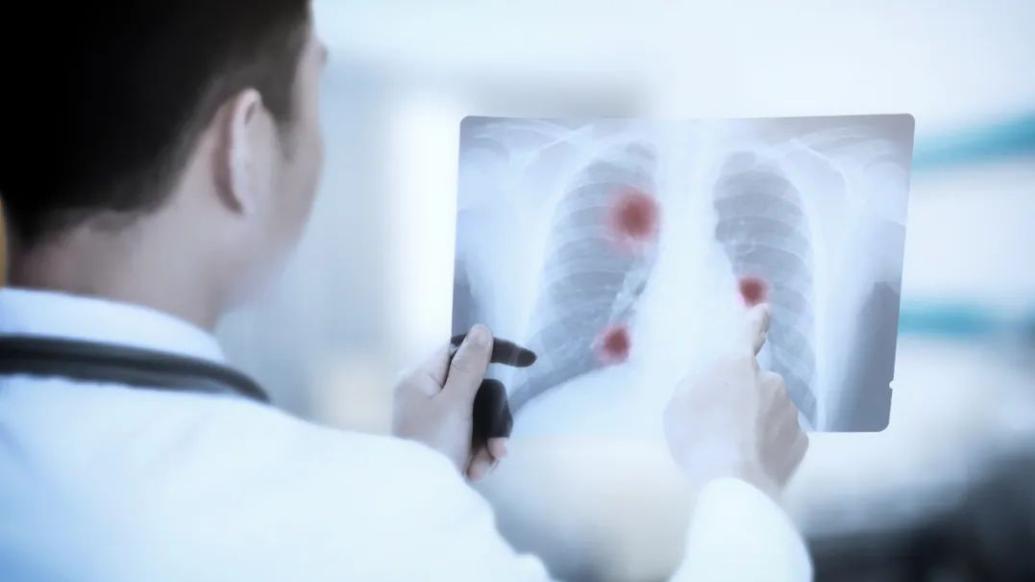 体检查出肺部结节该怎么办，如何随访观察才不会耽误治疗？