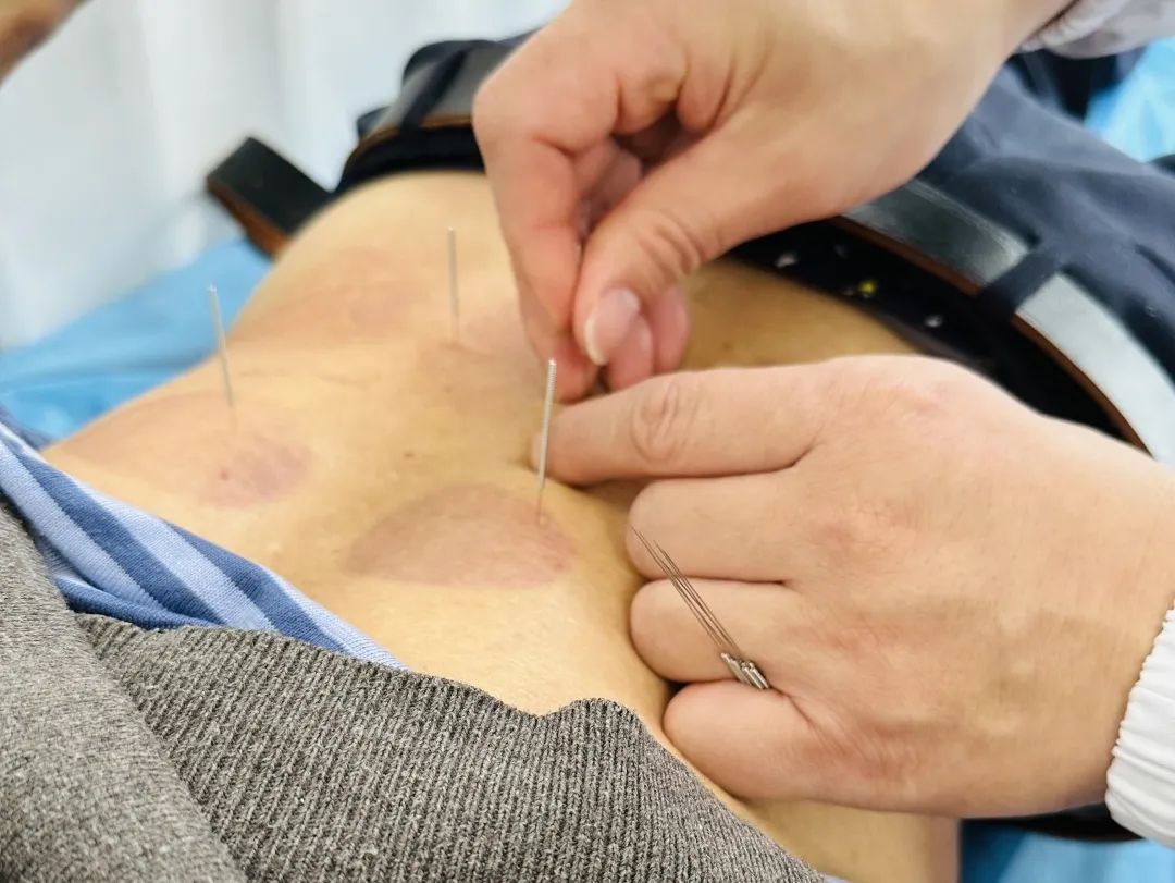 经仔细辨证,反复推敲,制定了"温针灸,芒针,电针疗法 功能康复锻炼"的