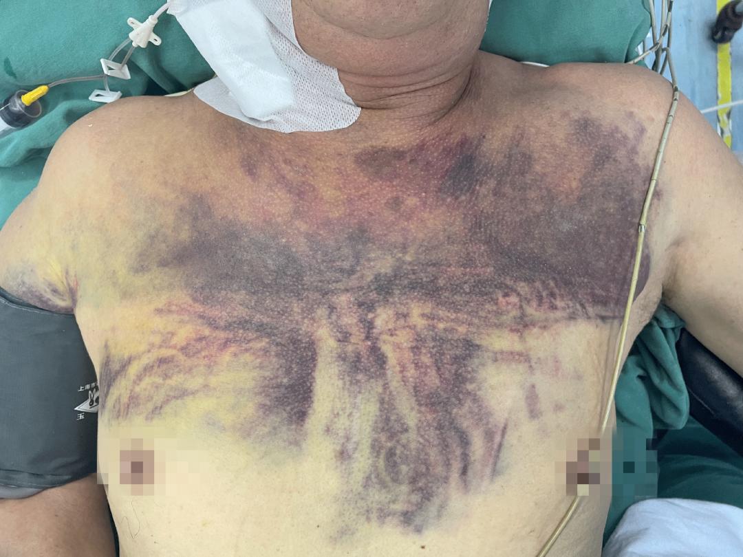 肋骨怎么记忆沪上首例！区中西医结合医院成功实施一例全胸腔镜下肋骨骨折内固定手术（反式TiNi记忆合金环抱式接骨…_https://www.jmylbn.com_新闻资讯_第1张