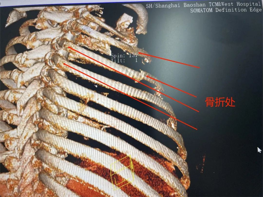 肋骨怎么记忆沪上首例！区中西医结合医院成功实施一例全胸腔镜下肋骨骨折内固定手术（反式TiNi记忆合金环抱式接骨…_https://www.jmylbn.com_新闻资讯_第2张
