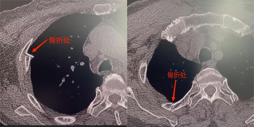 肋骨怎么记忆沪上首例！区中西医结合医院成功实施一例全胸腔镜下肋骨骨折内固定手术（反式TiNi记忆合金环抱式接骨…_https://www.jmylbn.com_新闻资讯_第3张