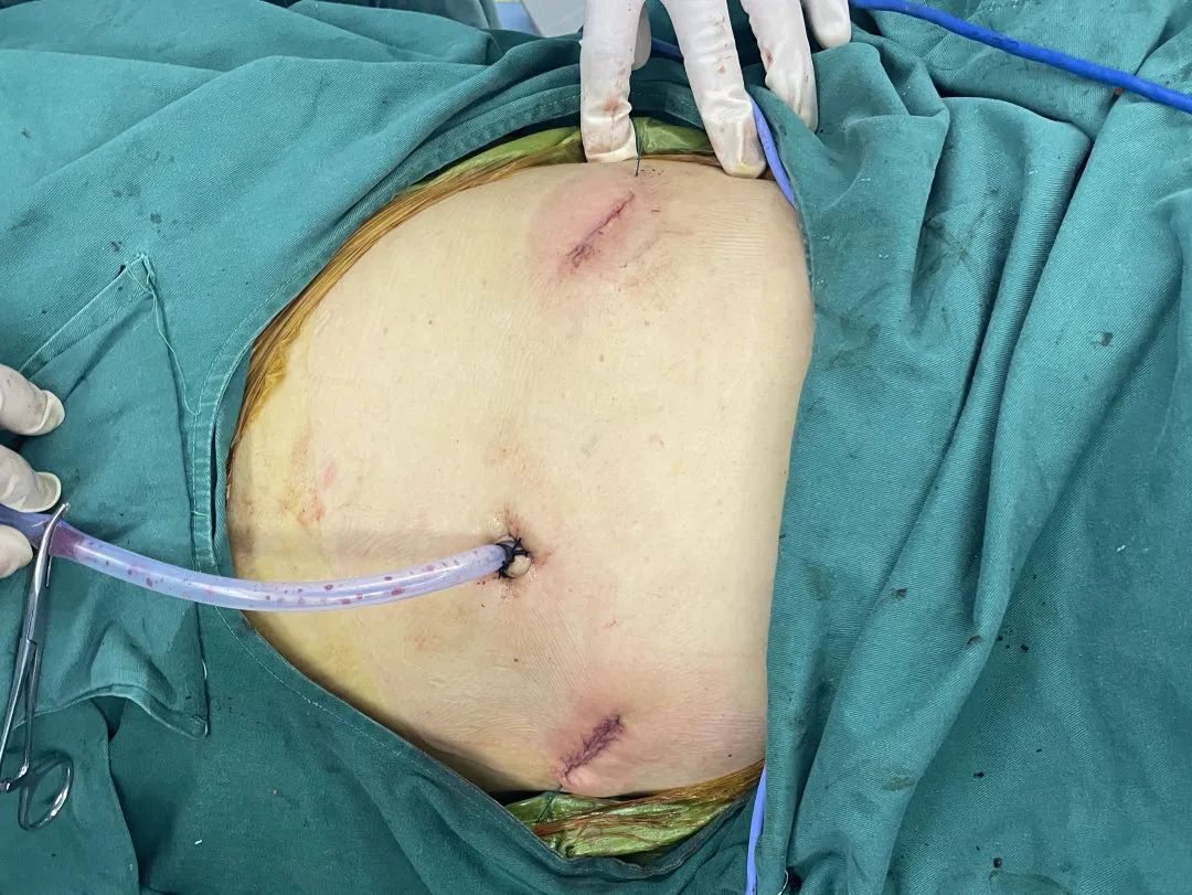 肋骨怎么记忆沪上首例！区中西医结合医院成功实施一例全胸腔镜下肋骨骨折内固定手术（反式TiNi记忆合金环抱式接骨…_https://www.jmylbn.com_新闻资讯_第4张