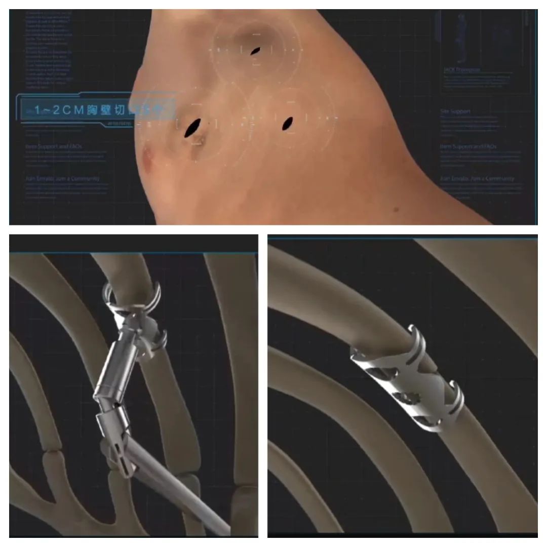 肋骨怎么记忆沪上首例！区中西医结合医院成功实施一例全胸腔镜下肋骨骨折内固定手术（反式TiNi记忆合金环抱式接骨…_https://www.jmylbn.com_新闻资讯_第5张