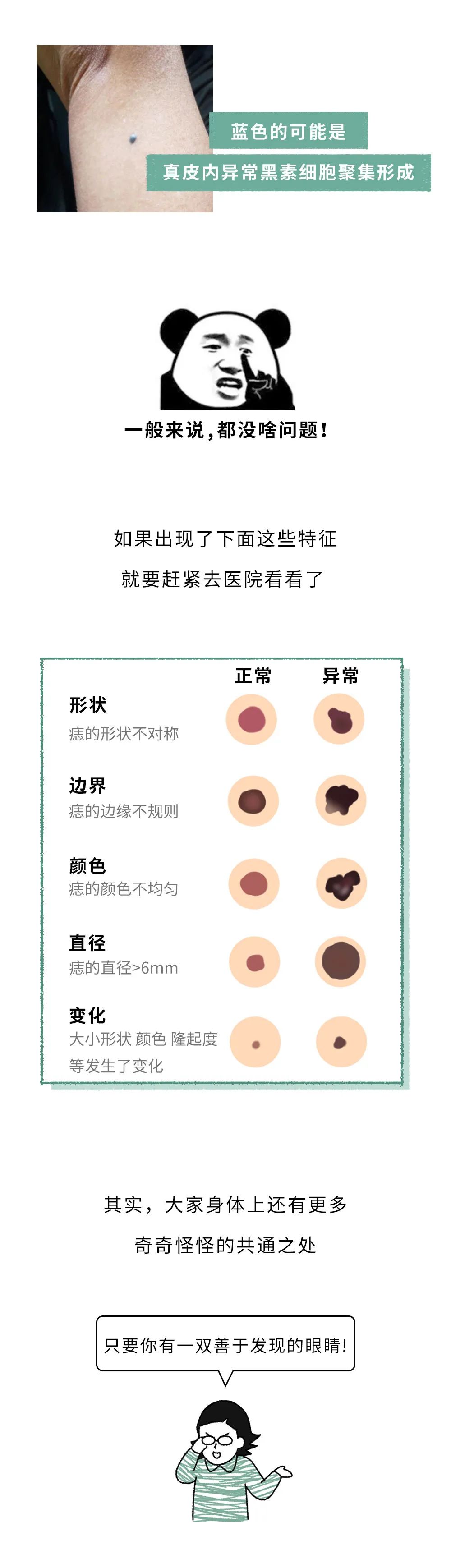 胳膊上长痣图解大全图片