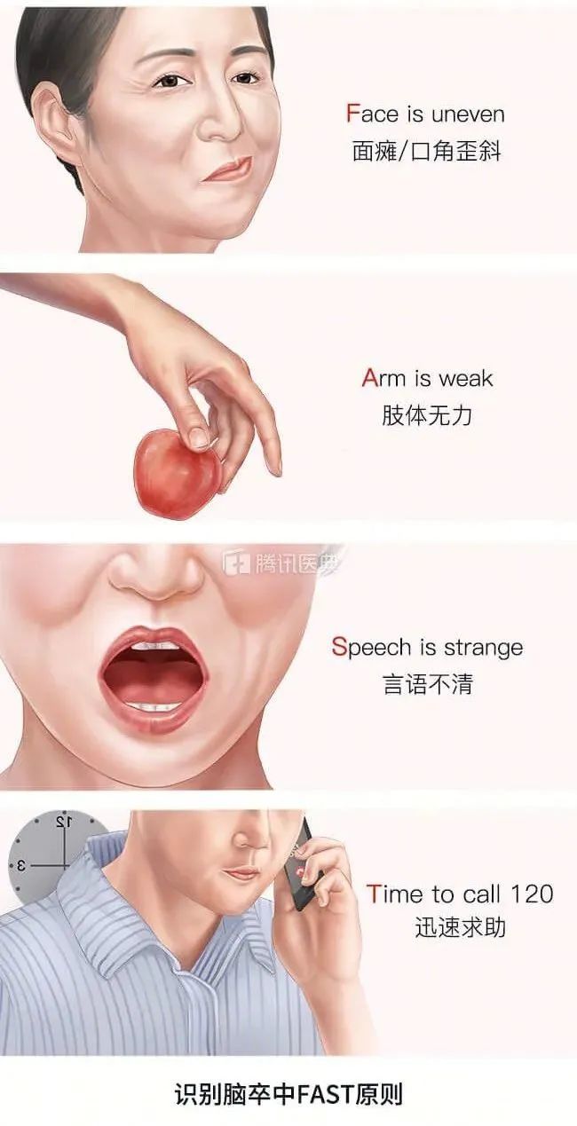 延误1分钟等于死亡190万脑细胞,如何预防中风?_澎湃号·湃客_澎湃新闻-The Paper