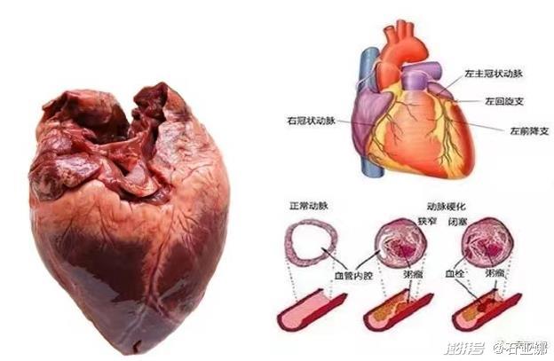 为什么要用留直针科普 ｜ 冠状动脉CT血管造影检查的那些事_https://www.jmylbn.com_新闻资讯_第1张