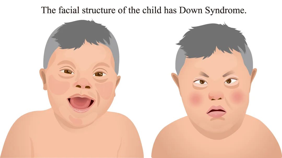 唐氏综合症儿童的外貌特征