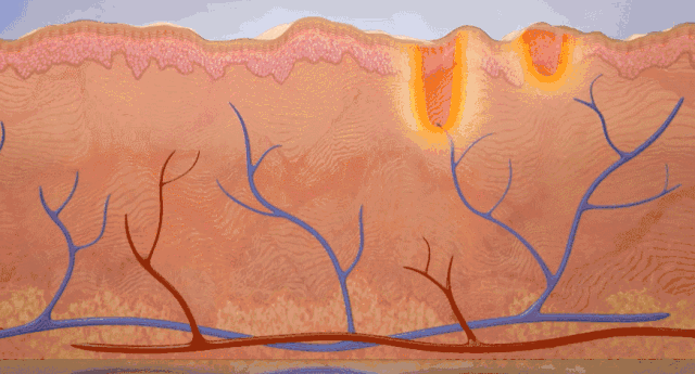 什么是光电治疗光电治疗适合什么样的瘢痕？_https://www.jmylbn.com_新闻资讯_第3张