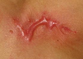 什么是光电治疗光电治疗适合什么样的瘢痕？_https://www.jmylbn.com_新闻资讯_第4张