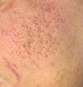 什么是光电治疗光电治疗适合什么样的瘢痕？_https://www.jmylbn.com_新闻资讯_第5张