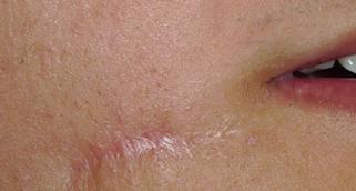 什么是光电治疗光电治疗适合什么样的瘢痕？_https://www.jmylbn.com_新闻资讯_第6张