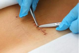 什么是光电治疗光电治疗适合什么样的瘢痕？_https://www.jmylbn.com_新闻资讯_第7张