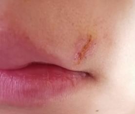 什么是光电治疗光电治疗适合什么样的瘢痕？_https://www.jmylbn.com_新闻资讯_第8张